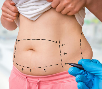 Plastic surgery doctor draw lines with marker on patient belly at clinic